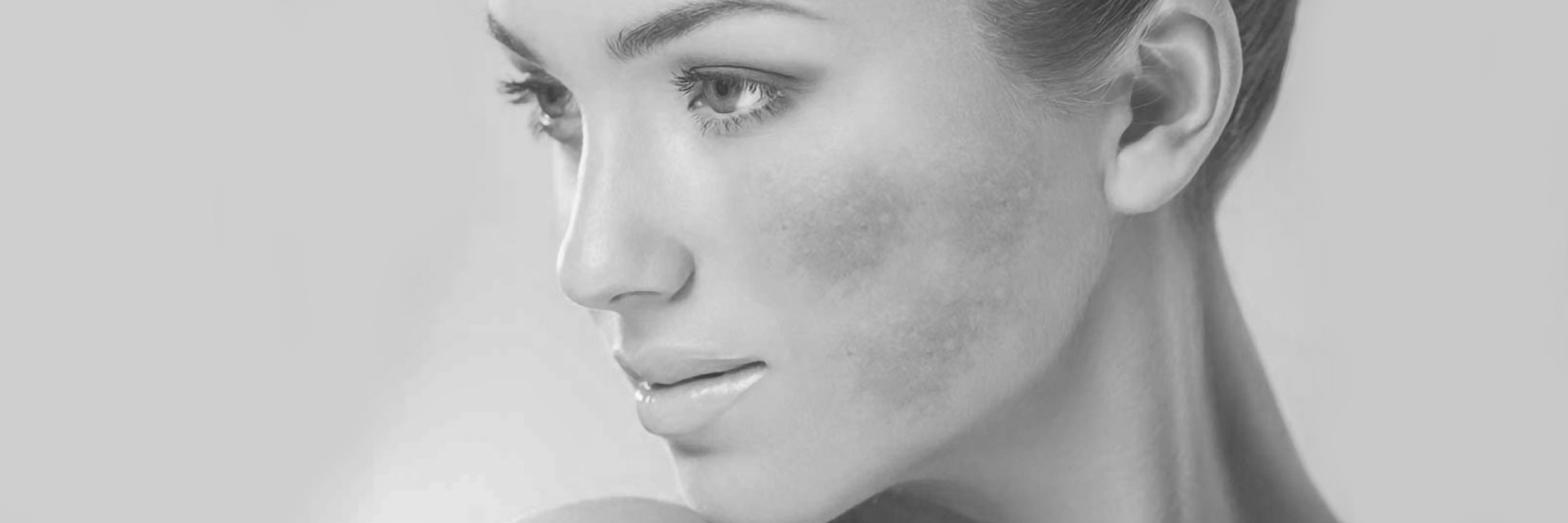 Melasma Dra Melina Kichler